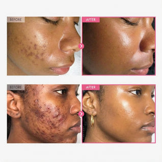 Alpha Arbutin + TXA Cream