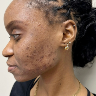 Week 1 skincare result