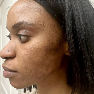 Week 3 skincare result
